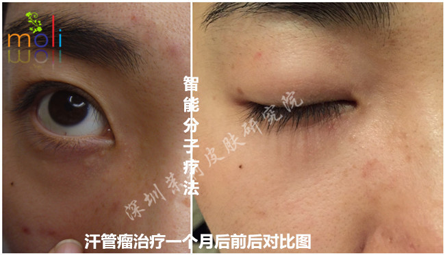 茉莉皮肤治疗汗管瘤前后对比图 茉莉皮肤医生与客户的聊天记录