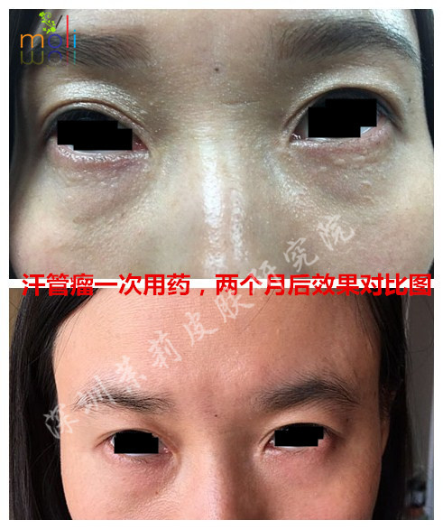 茉莉皮肤治疗汗管瘤前后对比图 茉莉皮肤治疗汗管瘤前后对比图