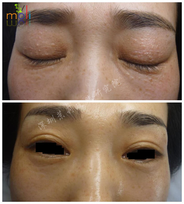 深圳茉莉皮肤治疗汗管瘤前后对比图