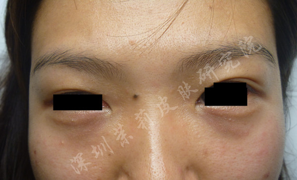 深圳茉莉皮肤治疗汗管瘤后