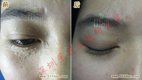 深圳茉莉皮肤去除汗管瘤前后对比图