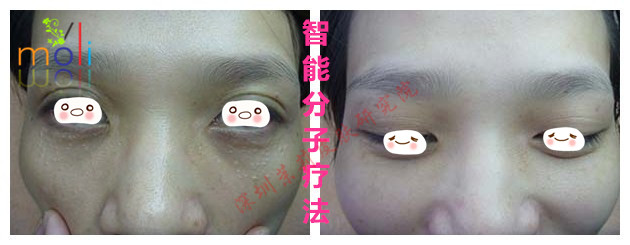 深圳茉莉皮肤去除汗管瘤前后对比图