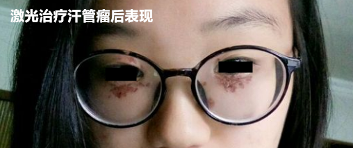 激光治疗汗管瘤 汗管瘤老是治不好?照她这样做,满脸汗管瘤疙瘩也能治好(图9)