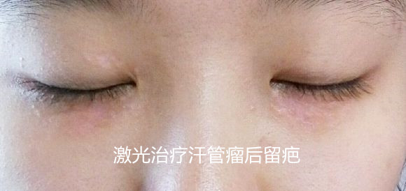 激光治疗汗管瘤 汗管瘤老是治不好?照她这样做,满脸汗管瘤疙瘩也能治好(图10)