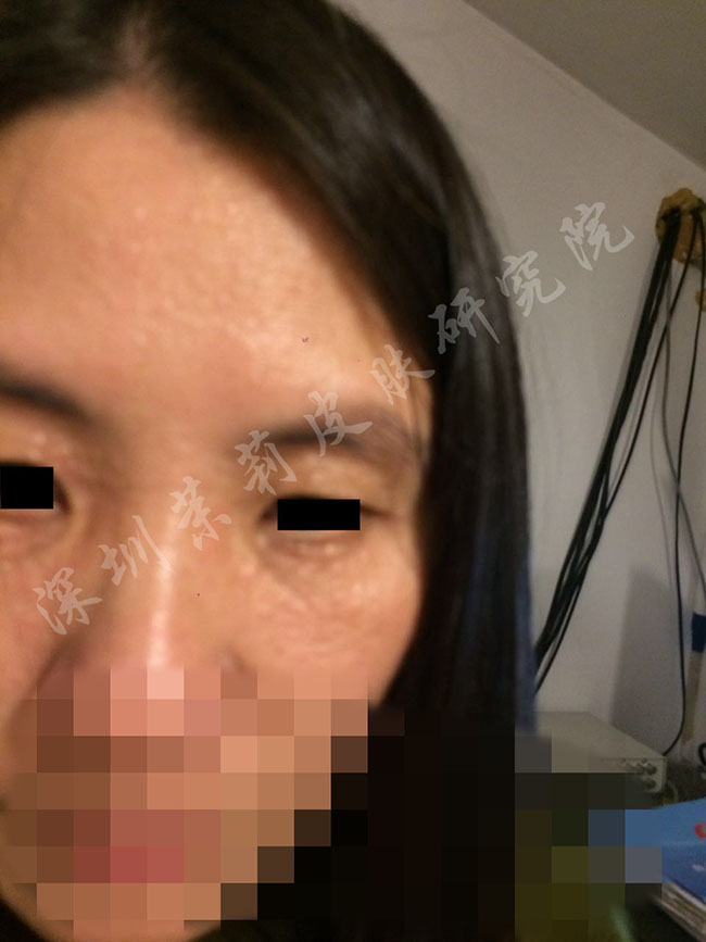 汗管瘤老是治不好?照她这样做,满脸汗管瘤疙瘩也能治好(图4) 汗管瘤治疗前