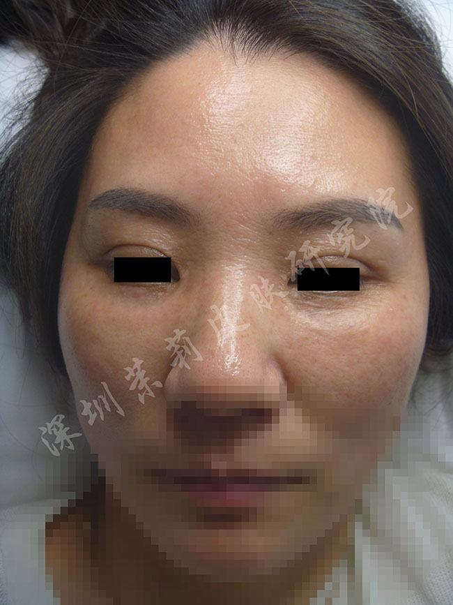 汗管瘤老是治不好?照她这样做,满脸汗管瘤疙瘩也能治好(图6) 在深圳茉莉皮肤治疗汗管瘤后