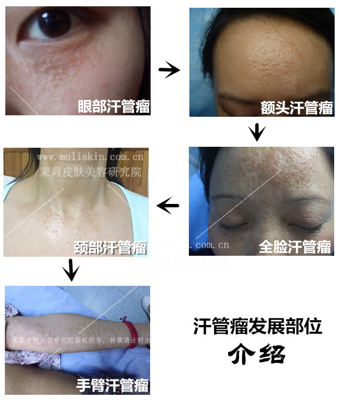汗管瘤发展部位介绍