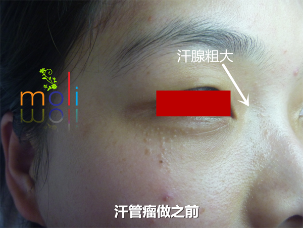 汗管瘤 汗管瘤