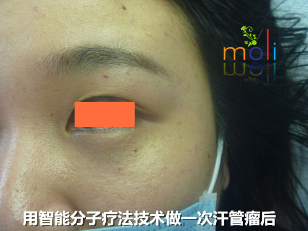 汗管瘤去除一次后的效果 汗管瘤长了16年,一次用药后变成这样……(图2)