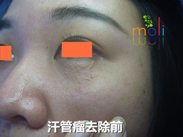 汗管瘤做之前 汗管瘤长了16年,一次用药后变成这样……(图1)