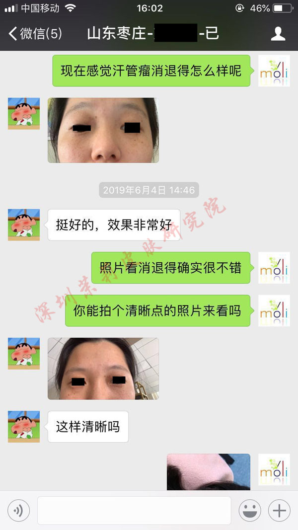 汗管瘤 汗管瘤