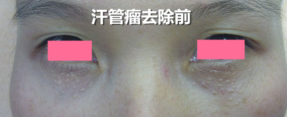 汗管瘤 汗管瘤