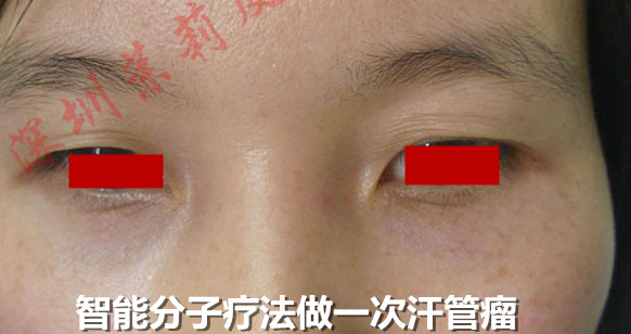 汗管瘤 汗管瘤