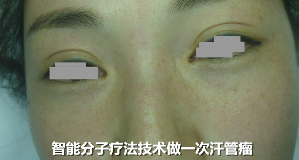 汗管瘤哪里能够看好?努力工作五年却因汗管瘤无法升职(图3) 汗管瘤哪里能够看好?努力工作五年却因汗管瘤无法升职(图3)