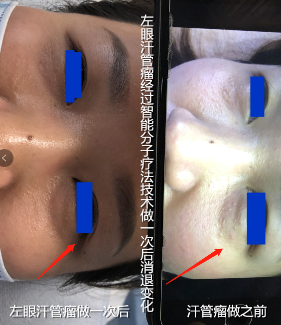 汗管瘤 汗管瘤