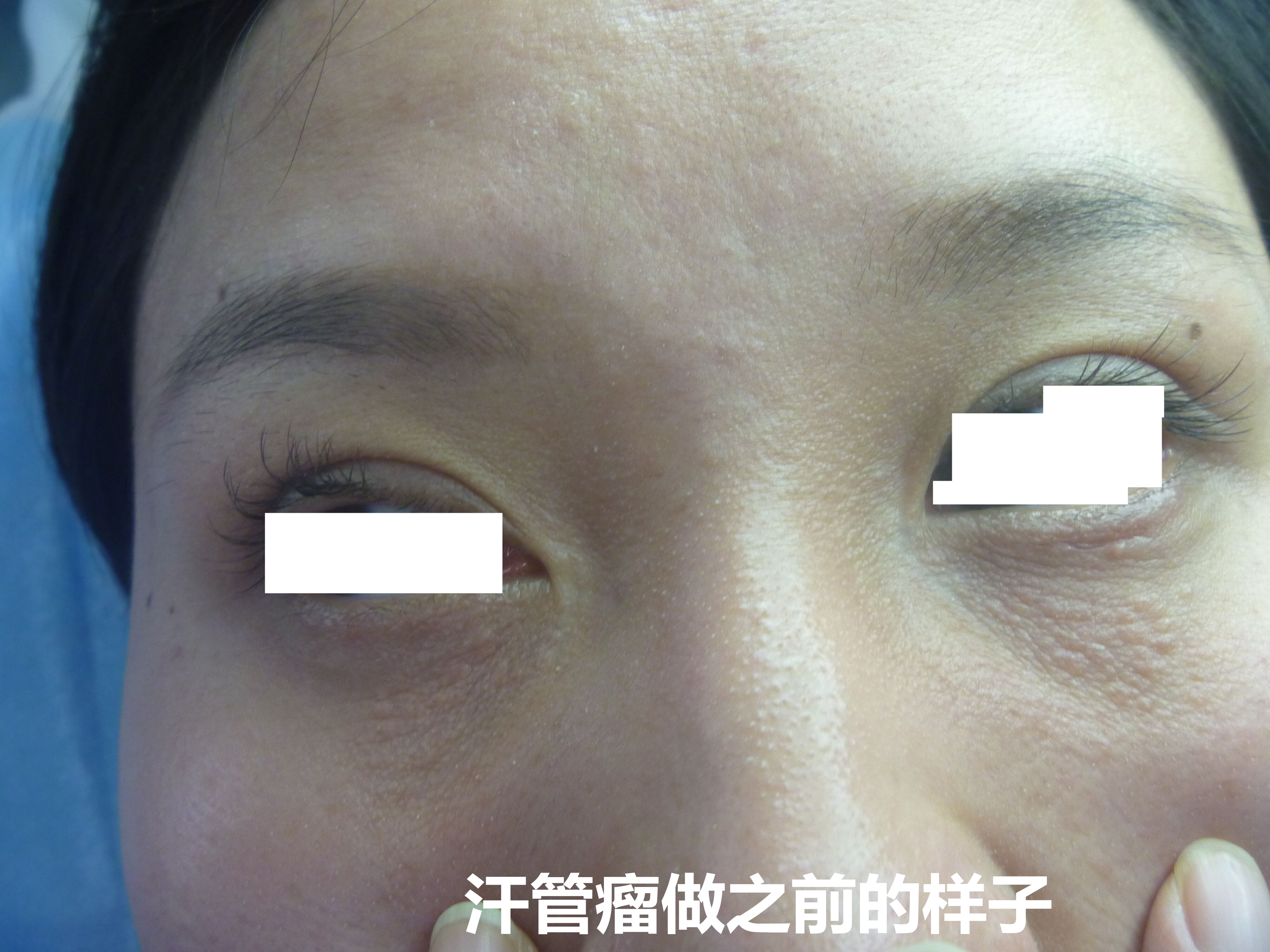 汗管瘤