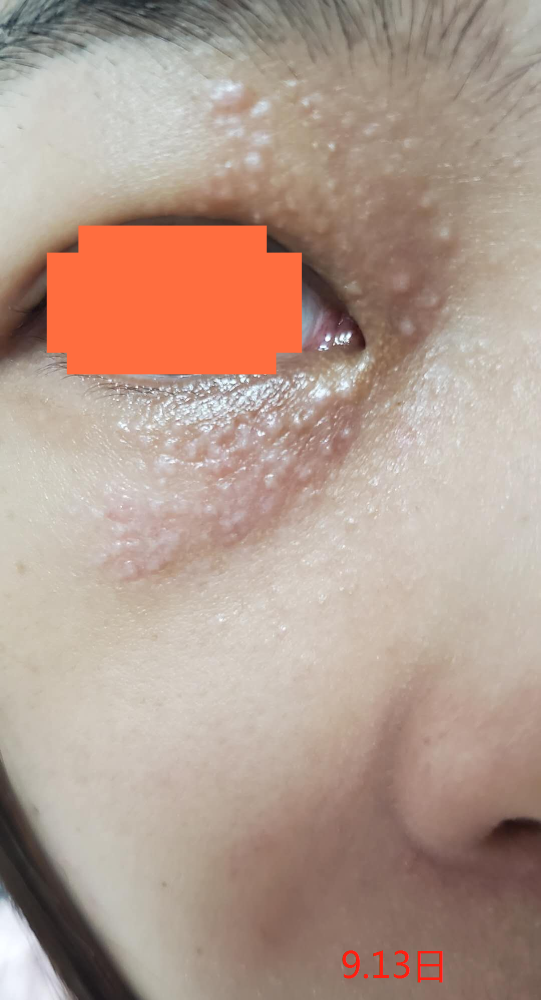 汗管瘤