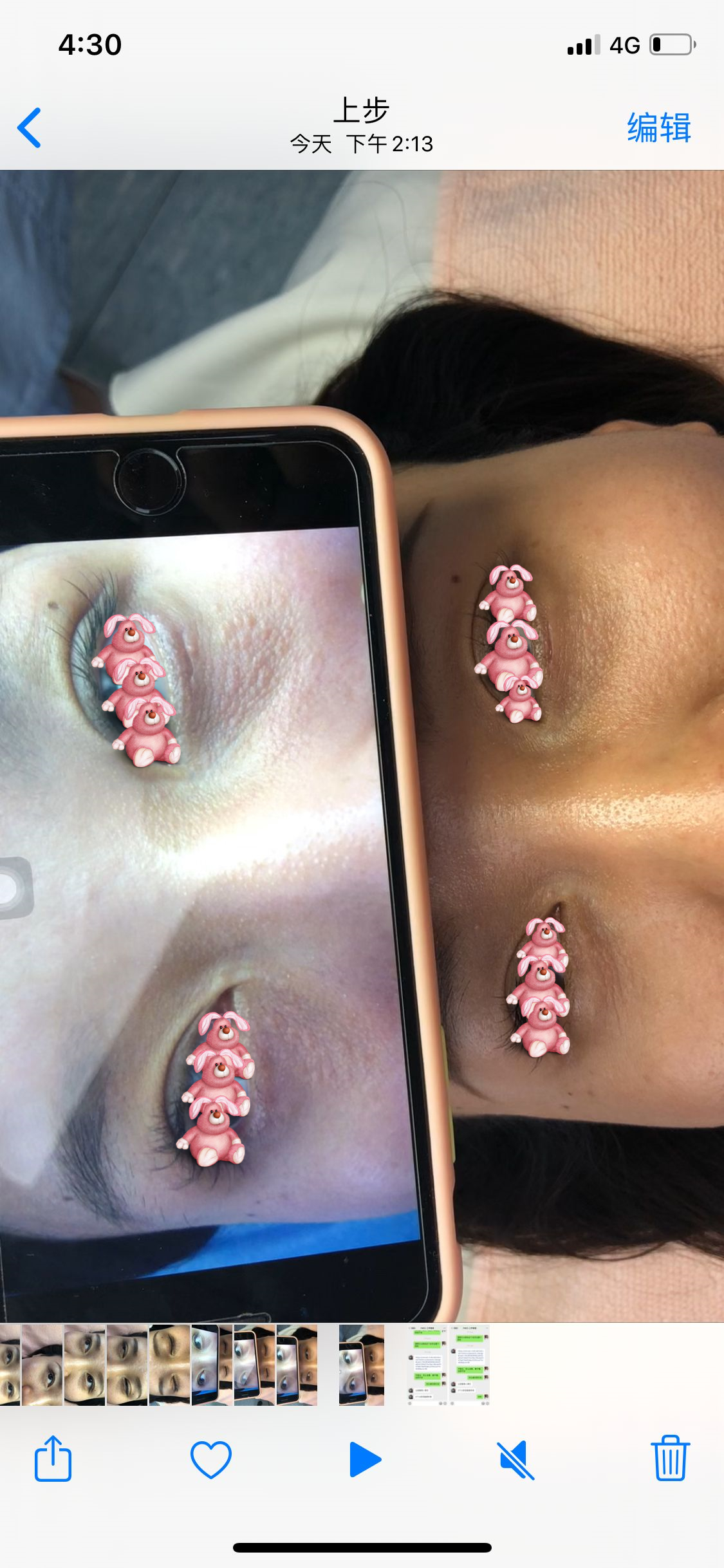 汗管瘤 汗管瘤