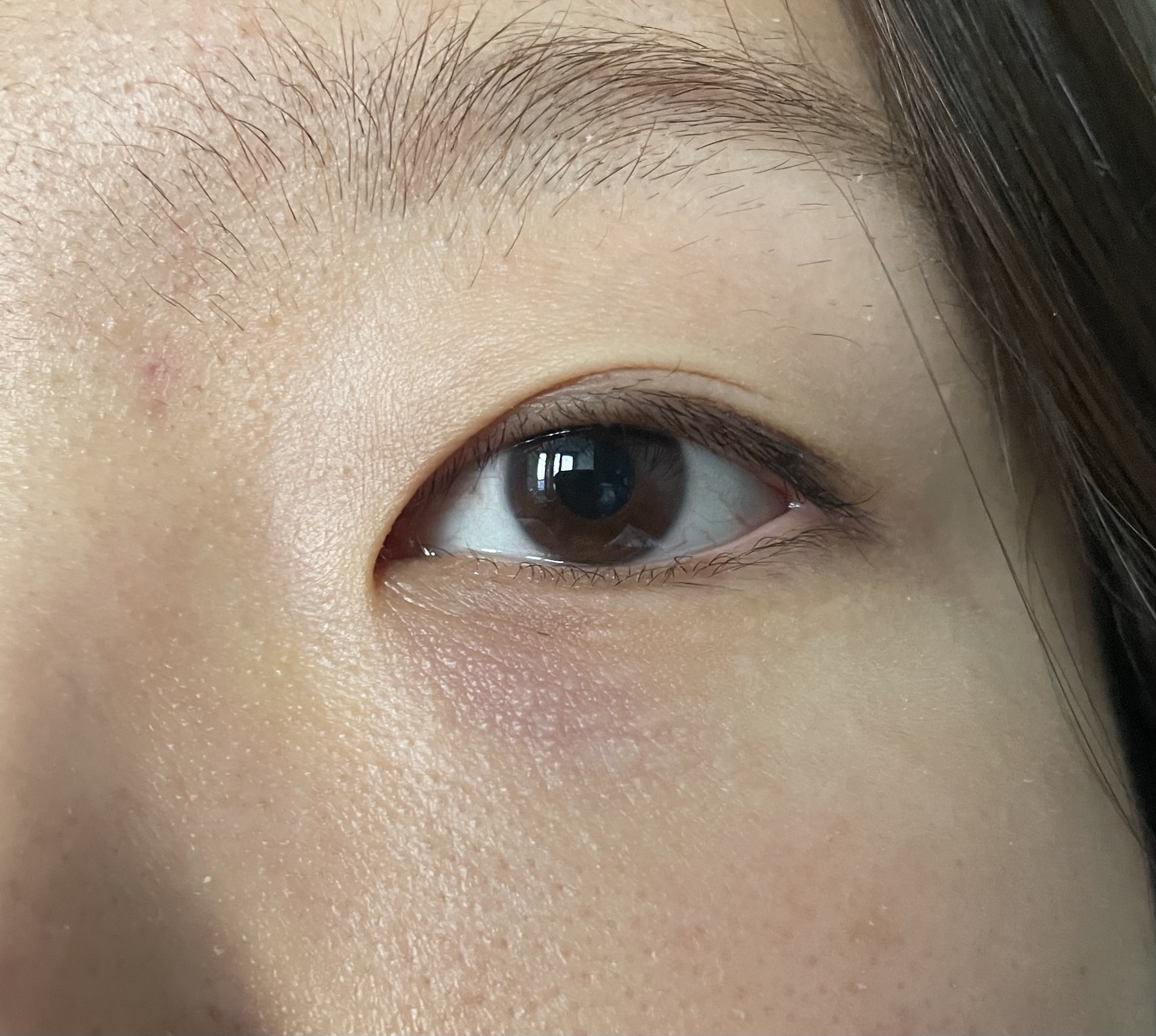 汗管瘤