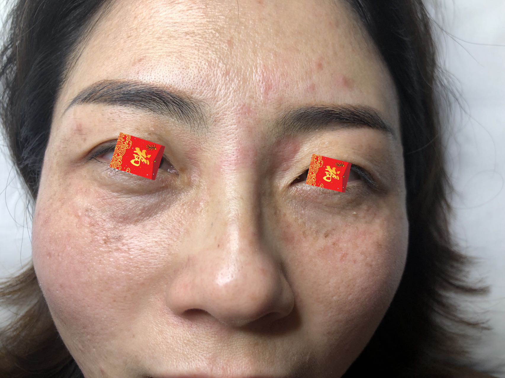 汗管瘤